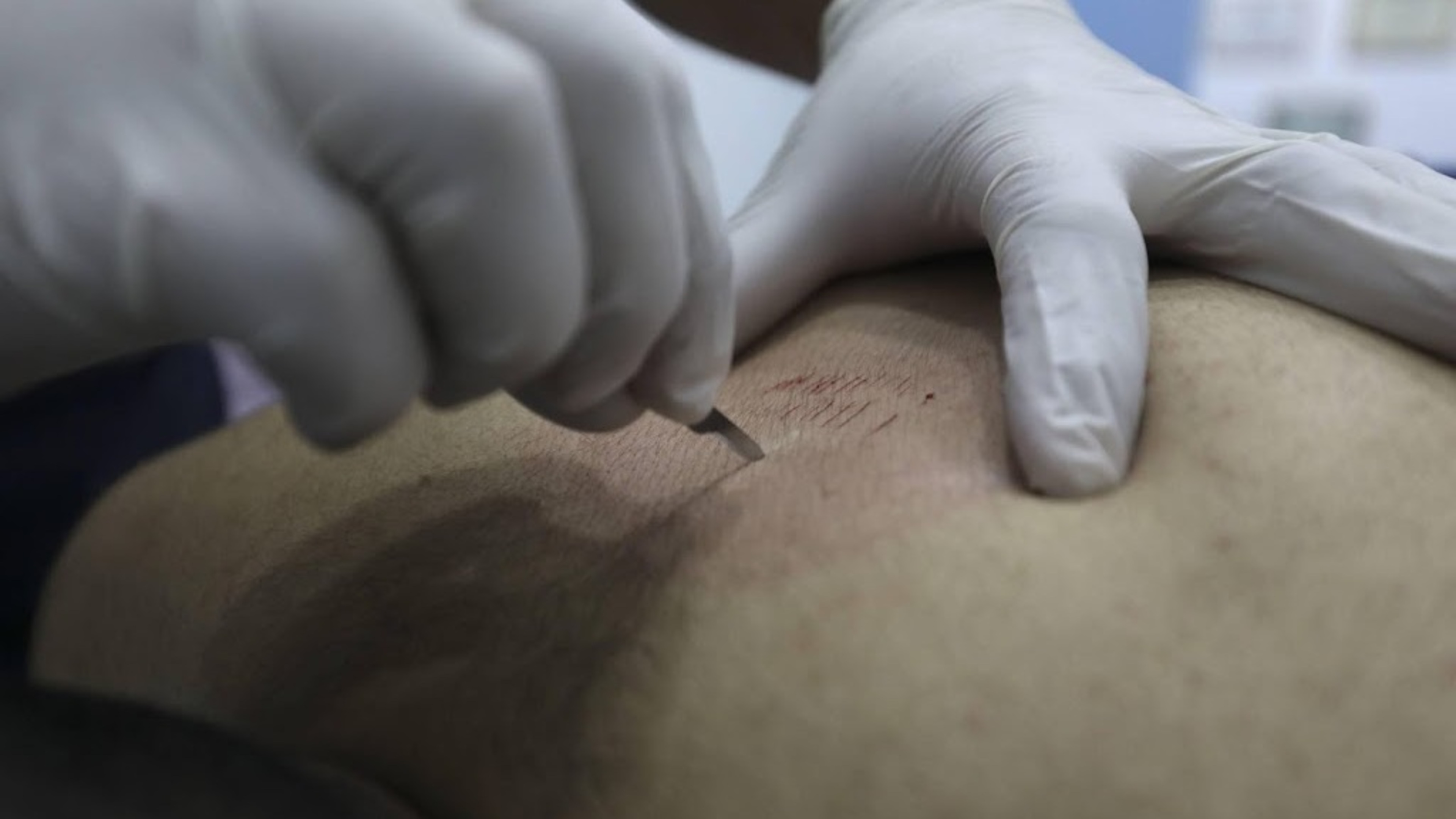 Providers of alternative 'wet cupping' treatment often unqualified