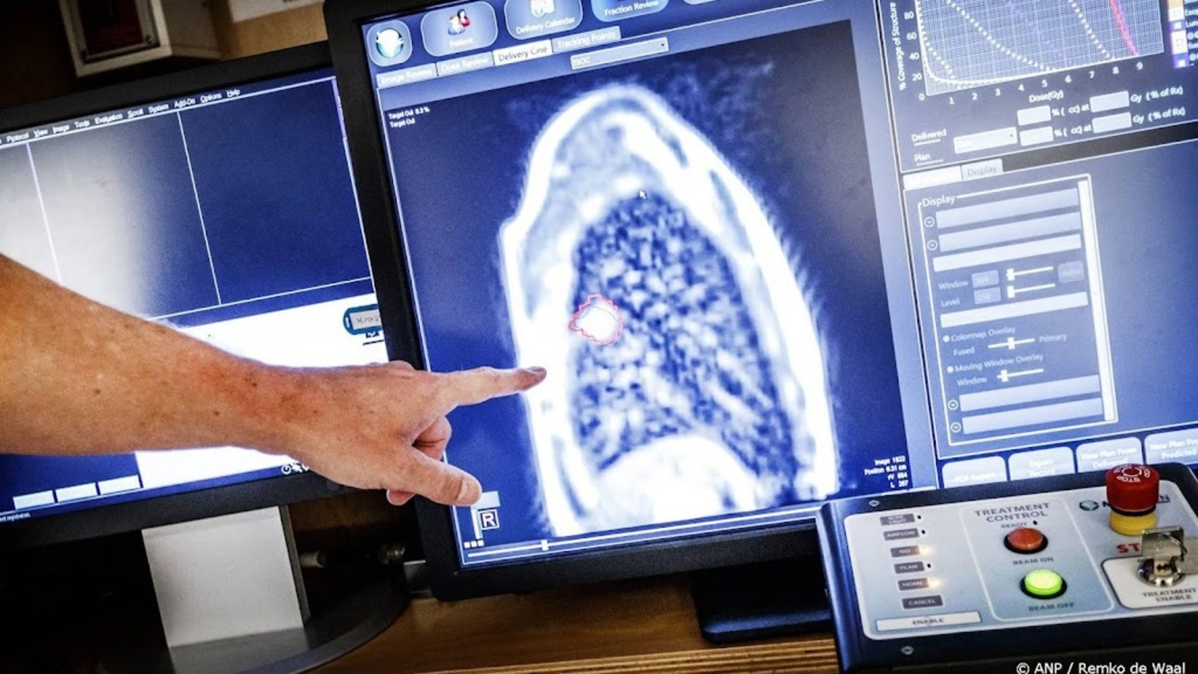 Eight in ten patients experience side effects from radiation therapy