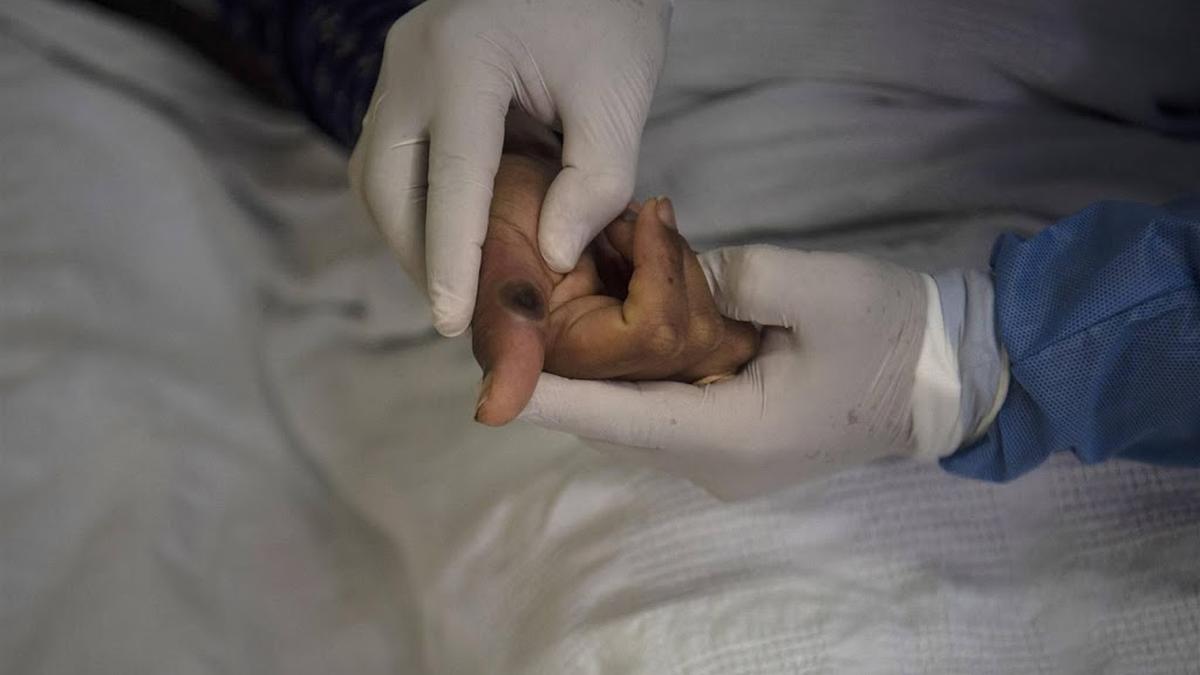 ECDC: monkeypox virus outbreak in Congo isn’t a risk to Europe